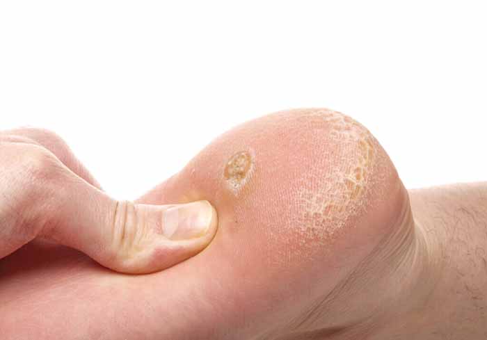The Complete Guide to Foot Calluses: Causes, Treatment, and Prevention